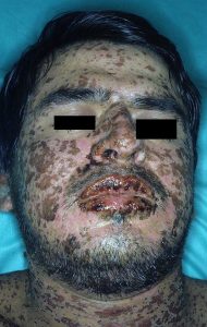 سندرم استیونس جانسون